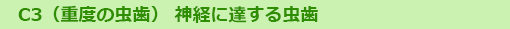 C3（重度の虫歯） 神経に達する虫歯