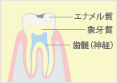 C1（軽度の虫歯） エナメル質の虫歯