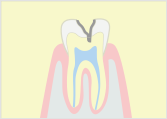 C2（中度の虫歯） 神経に近い象牙質の虫歯