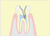 C3（重度の虫歯） 神経に達する虫歯