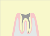 C4（最重度の虫歯） 末期の虫歯