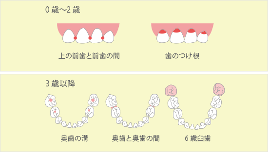 虫歯になりやすい場所