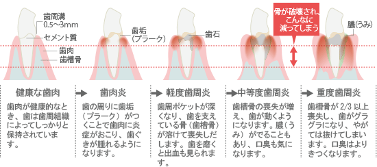 歯周病の症状と進行の様子